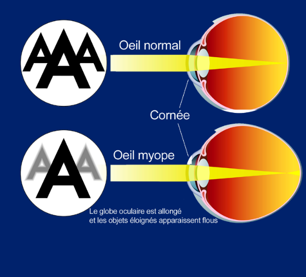 Opération de la myopie