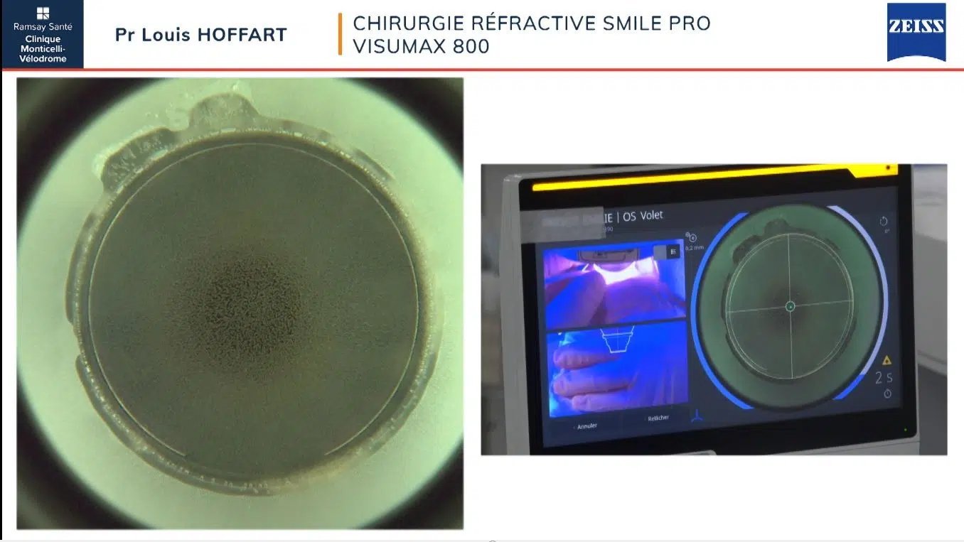 chirurgie réfractive smile pro