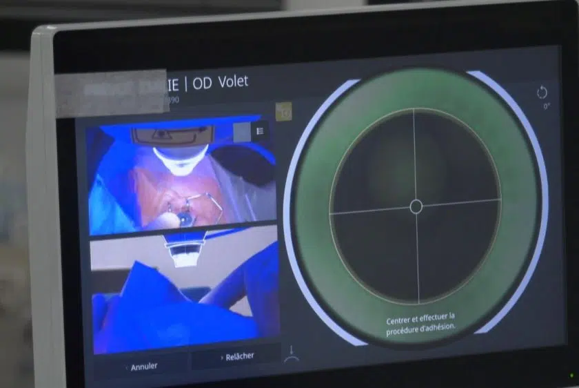 opération smile avec femtoseconde zeiss